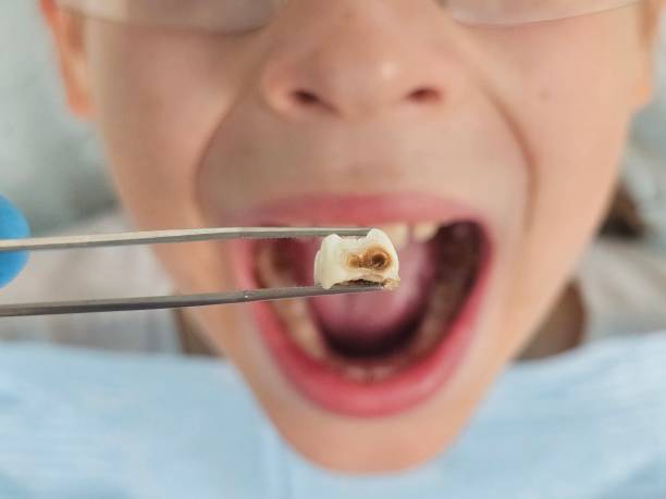 Best Emergency Broken Tooth Repair in North Fort Myers, FL